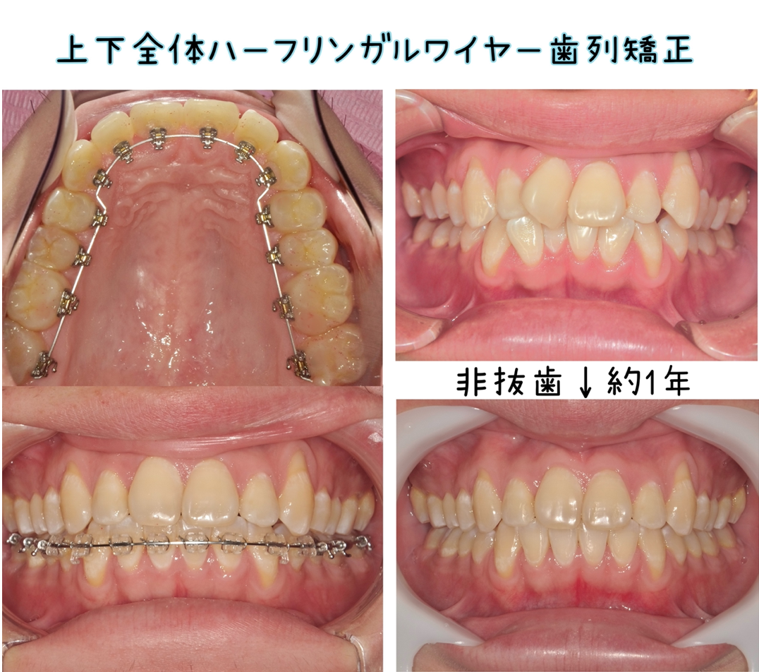 ハーフリンガルワイヤー矯正の治療例