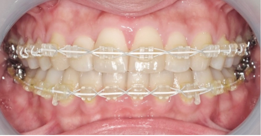 表側のワイヤー矯正の治療例
