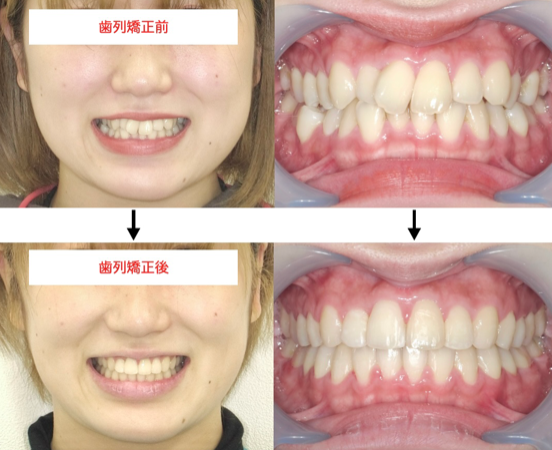 表側のワイヤー矯正の治療例