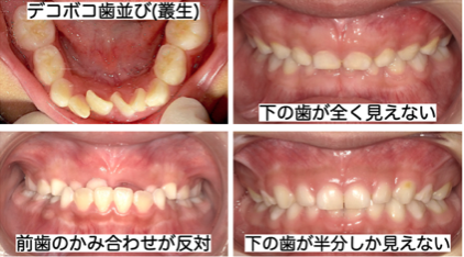 現代のこども達の典型的な乳歯列